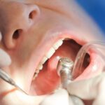 Diş Çürüğünde Beslenmenin Önemi